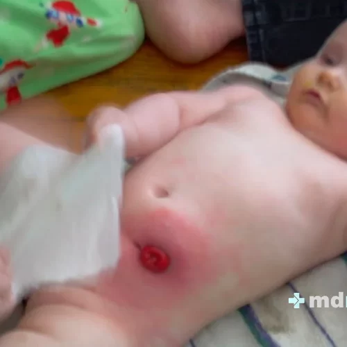 ColostomíaIleostomía