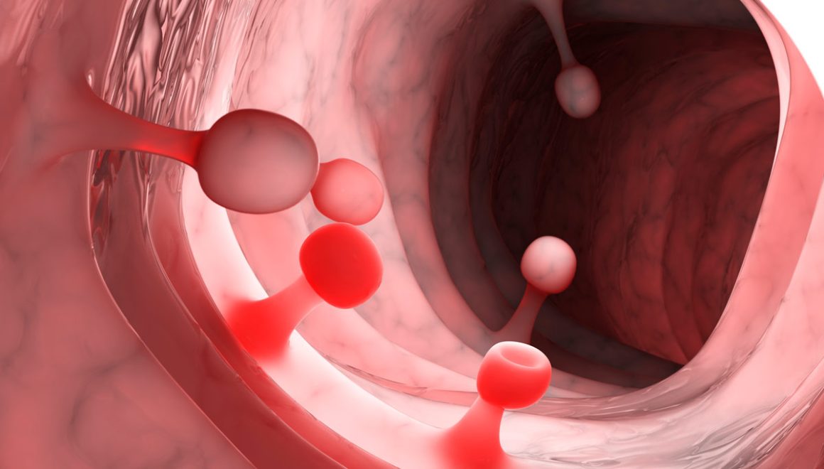 Pólipos rectales colónicos e intestinales