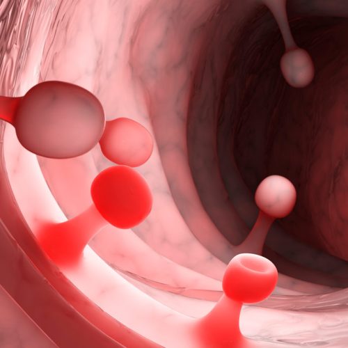 Pólipos rectales colónicos e intestinales