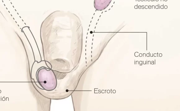 Testículos no descendidos