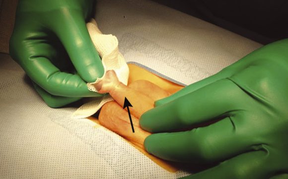 Liberación de sinequias prepuciales